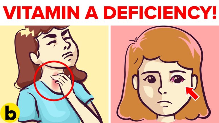 5 Hidden Signs Of Vitamin A Deficiency You Should Not Ignore