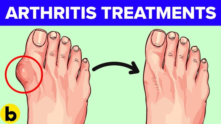 9 Strange Arthritis Treatments That Actually Work