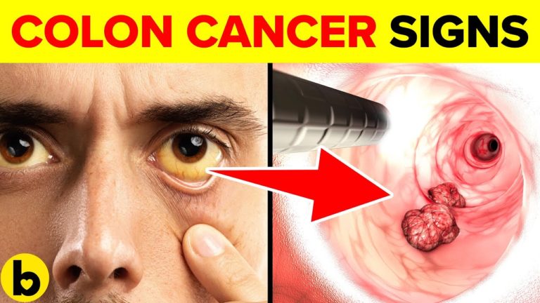 11 Early Signs Of Colon Cancer You NEED TO KNOW