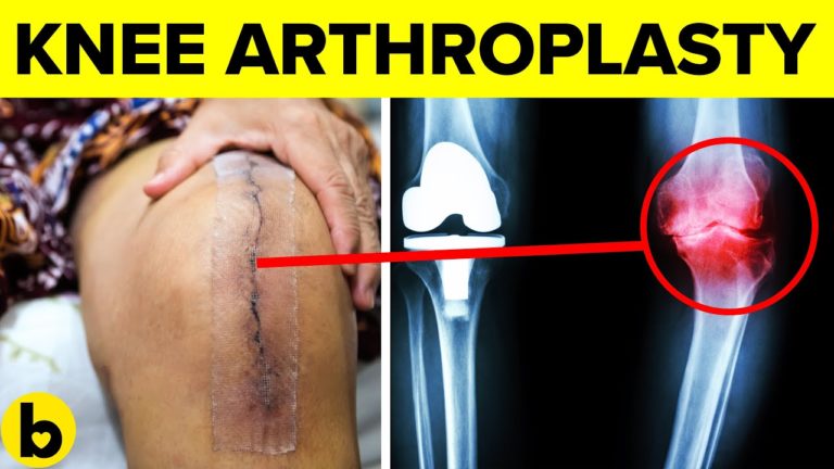 12 Things You Should Know About Knee Arthroplasty Surgery & Knee Health