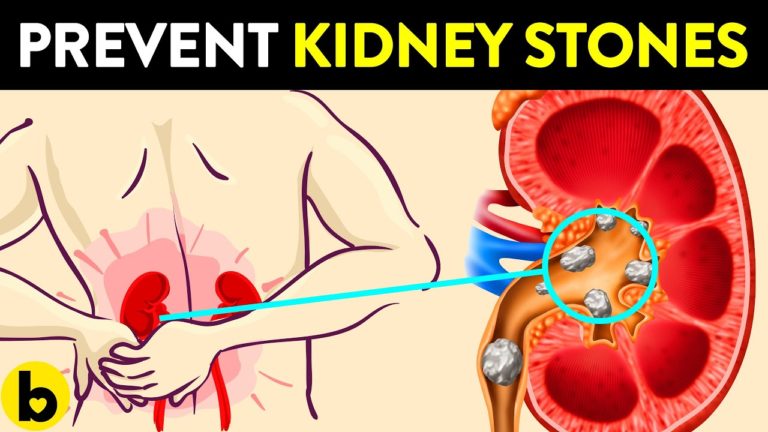 Knowing This About Kidney Stones Can Save Your Life