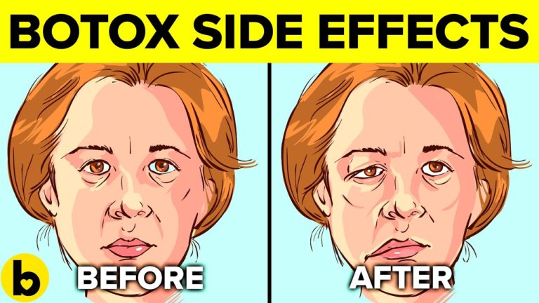 5 Side Effects Of Botox Injections You Should Be Aware Of