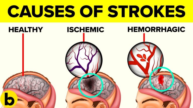 17 Causes Of A Stroke That Will Surprise You