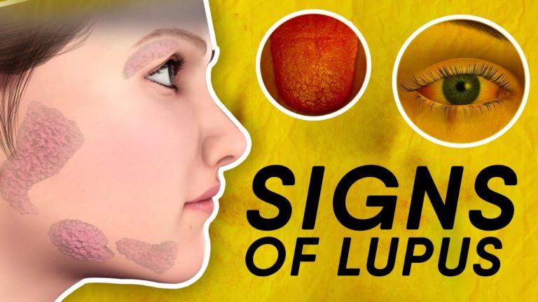 11 Signs Of Lupus You Should Not Ignore