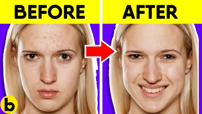 Get Rid Of Acne Using This One Ingredient