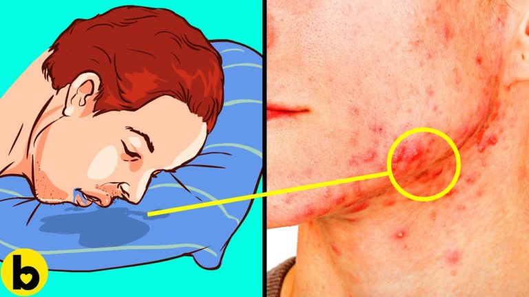 7 Things You Didn’t Know Gave You Acne