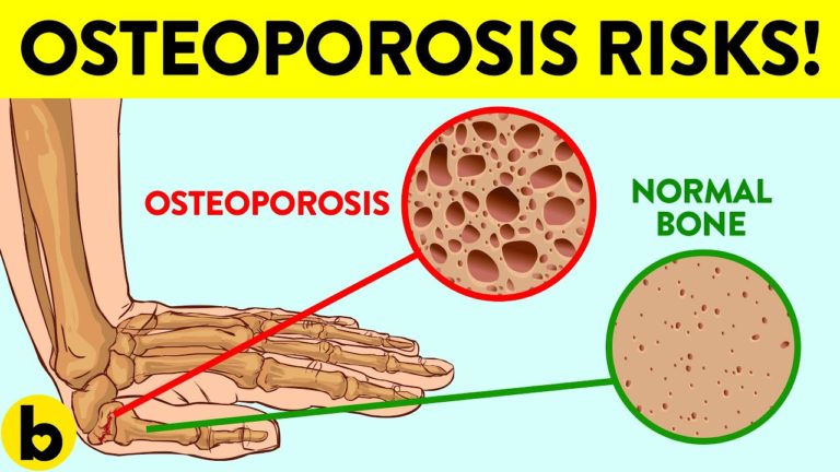 13 Early Warning Signs You’re At Risk For Osteoporosis