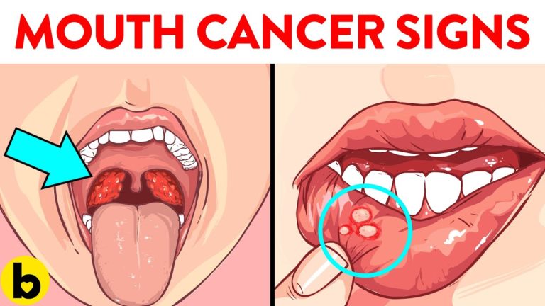 6 Early Signs of Mouth Cancer You Should Not Ignore