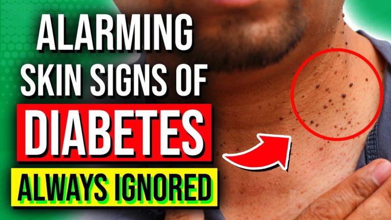 8 ALARMING Skin Signs Of Diabetes You Should NOT Ignore