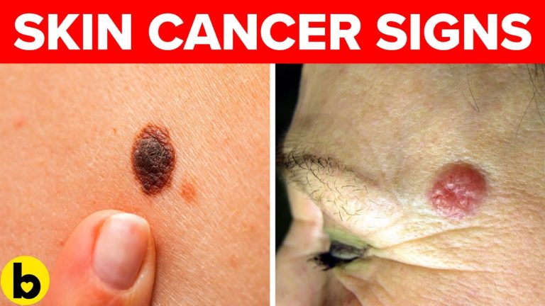 Early Skin Cancer Signs You Must Watch Out For