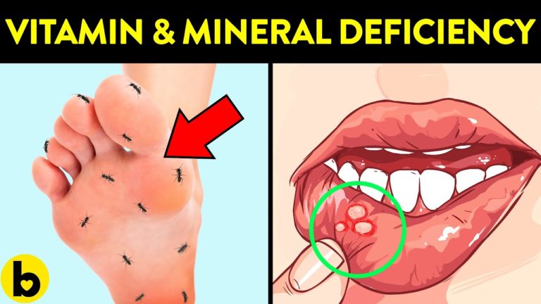 6 Signs That You May Have Vitamin And Mineral Deficiency