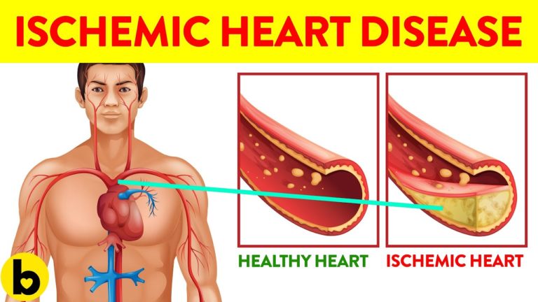 7 Ways You Can Get Ischemic Heart Disease