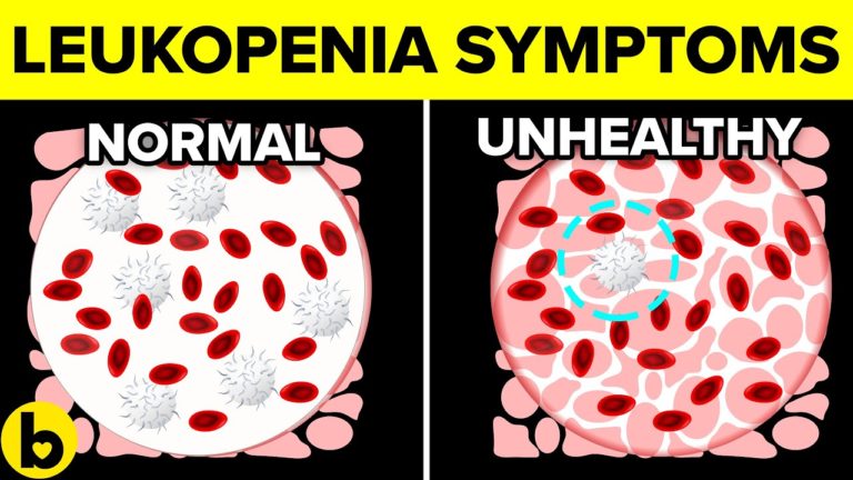 8 Causes Of Leukopenia You Should Be Cautious Of