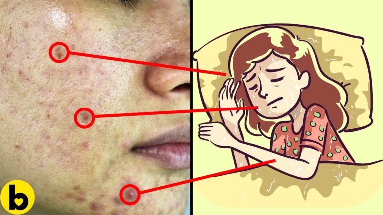 15 Mind-Blowing Reasons You Keep Getting Acne