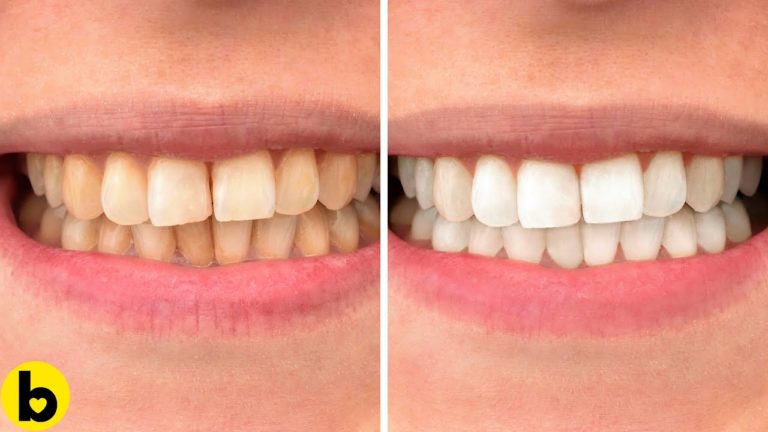 5 Ways To Whiten Your Teeth Naturally