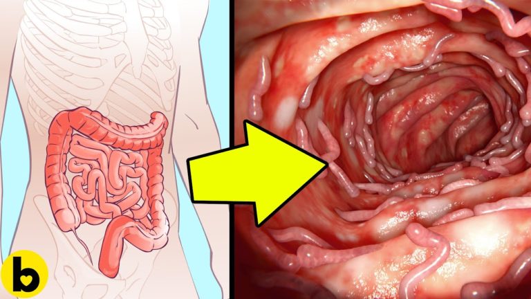 5 Home Remedies For Natural Colon Cleansing