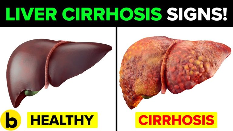 6 Ways You’ll Get Liver Cirrhosis