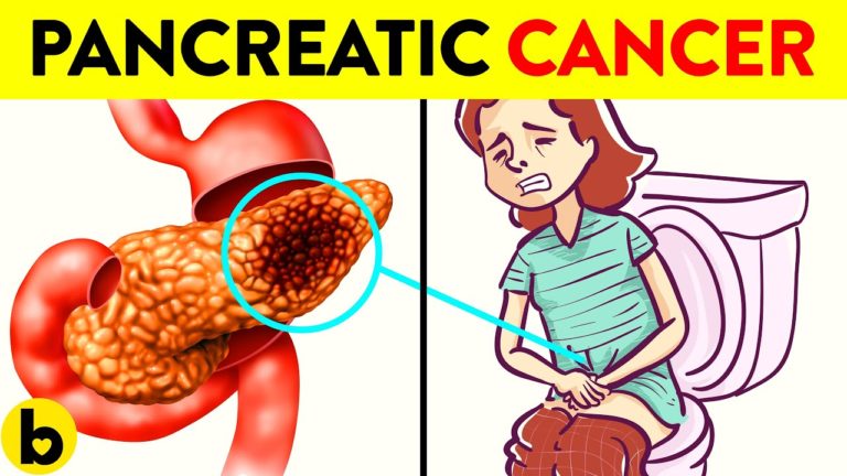 7 Signs Of Pancreatic Cancer You Should Not Ignore